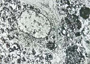 F,68y. | spleen - myelinoid inclusions - clin. susp. leukemia